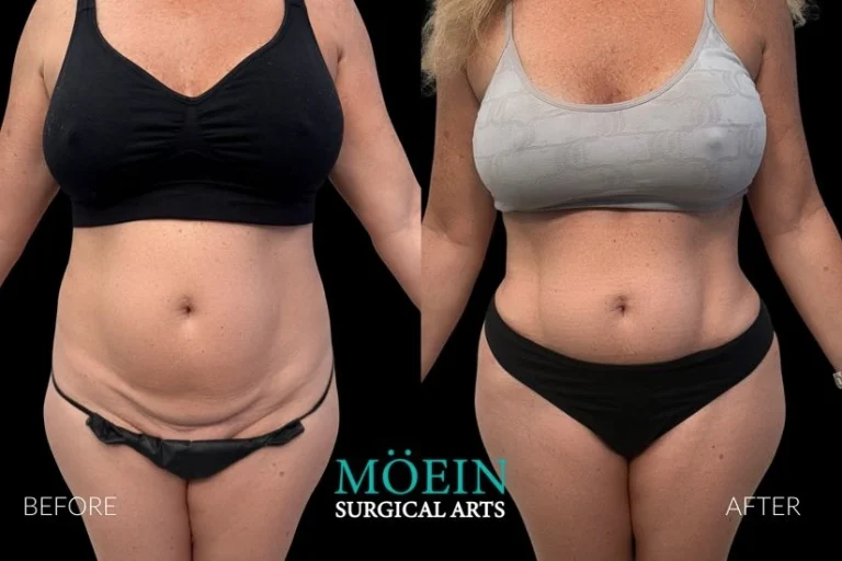 Lipo 360 Before and After in LA 768x512 1