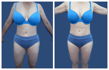 Body Contouring vs Liposuction