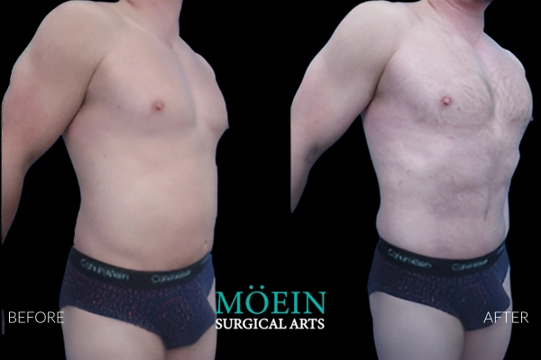 Abdominal Liposuction Results for men in Los Angeles