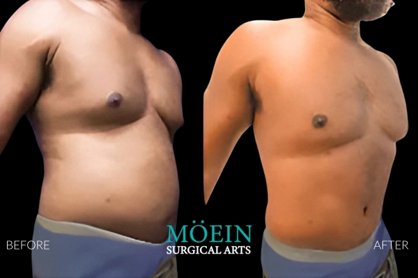 Abdominal Liposuction Results for men in Los Angeles