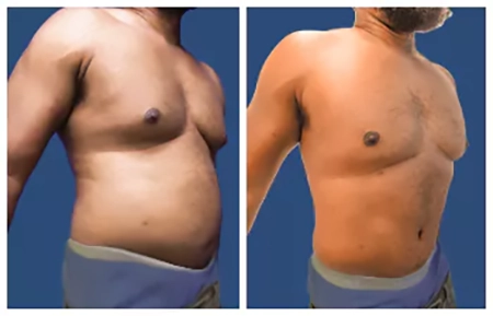 Before and after comparison of a shirtless man showing weight loss, with a noticeable reduction in abdominal size.