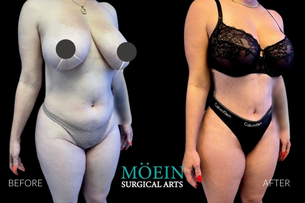Liposuction Before and After LA CA 2 1