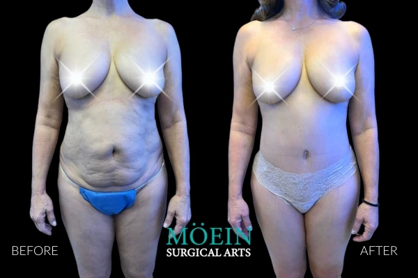 Liposuction Before and After in LA CA