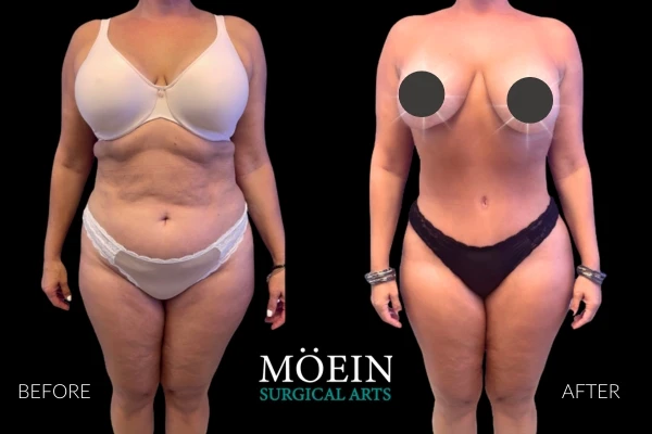 Liposuction Before and After in LA CA 3 2