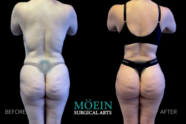 Liposuction Best Results Los Angeles CA 1 1