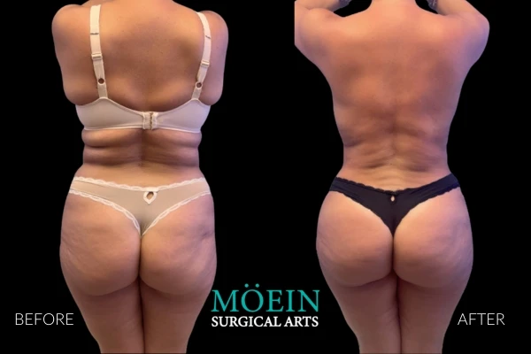 Liposuction Results Los Angeles CA 2 1