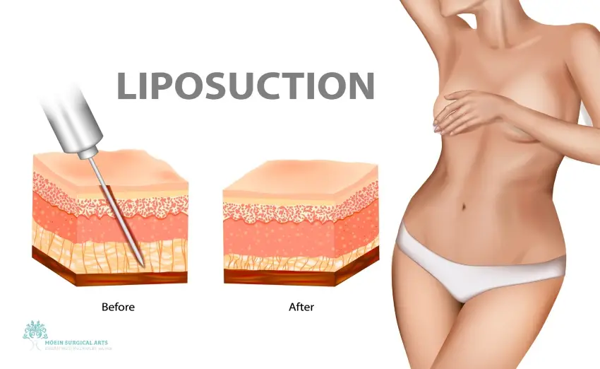 Liposuction for Buffalo Hump Removal Liposuction for Buffalo Hump Removal