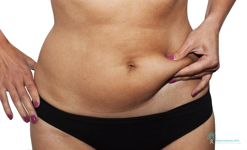 Loose Skin after Sono Bello- Tips from Dr. Moein