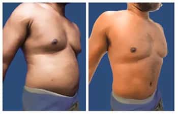 Side-by-side comparison of a male torso before and after weight loss, showing reduced size and improved muscle tone.