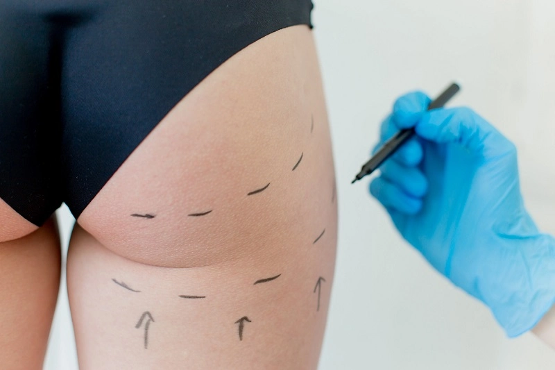 Lower Body Lift in Los Angeles