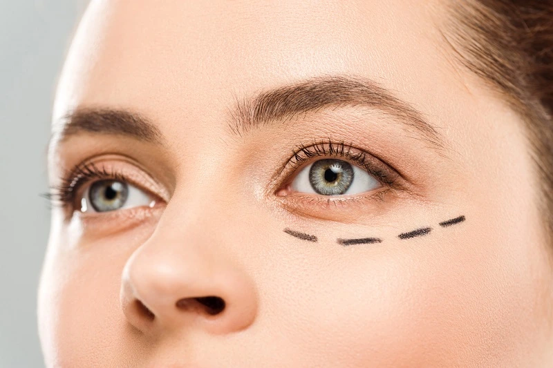Lower Eyelid Surgery Schedule Your Consultation with Dr. Moein