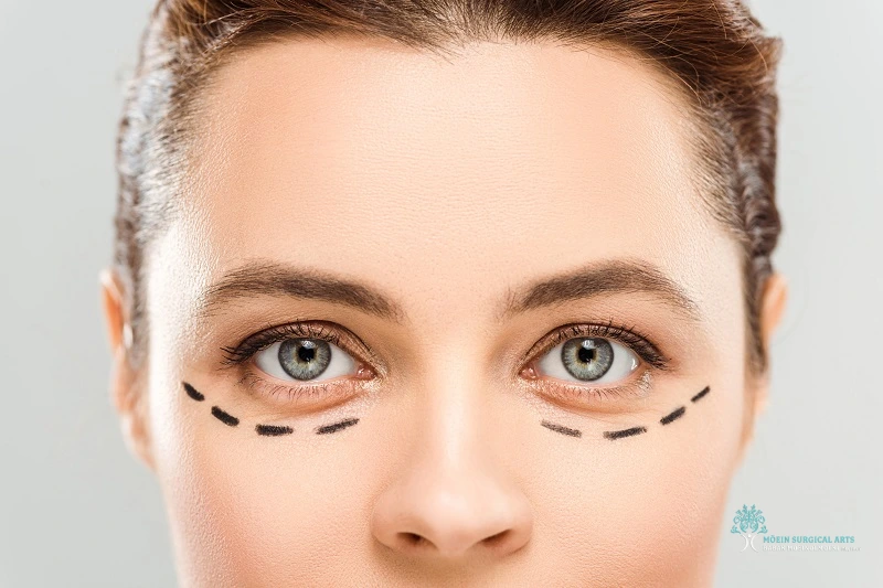 Lower Eyelid Surgery in Los Angeles