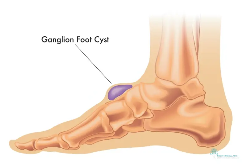 Lump and Bump Removal Clinic Services Los Angeles Lump and Bump Removal Clinic Services Los Angeles