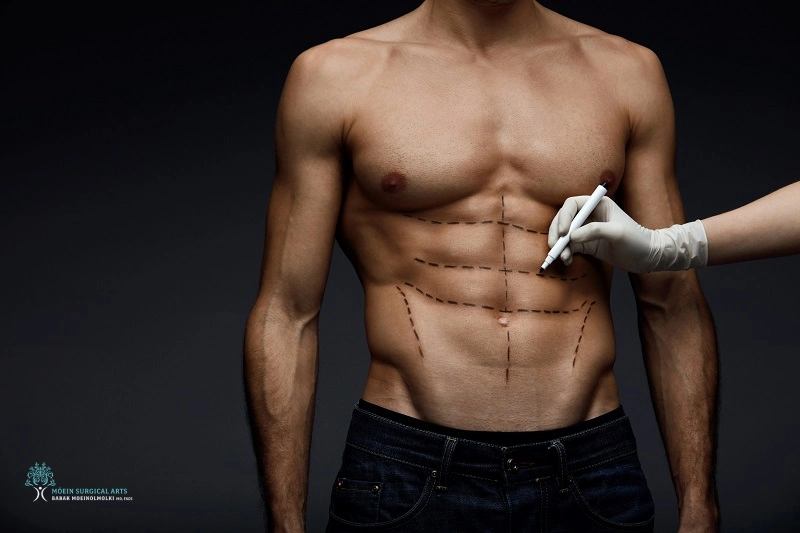 Male Liposuction Los Angeles