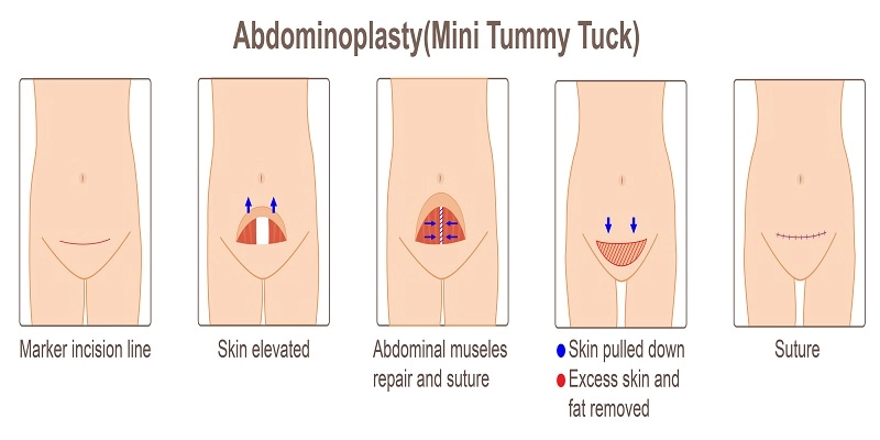 Mini Tummy Tuck in LA