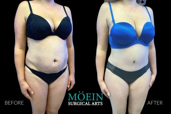 Mommy-Makeover-Before-and-After-LA-CA