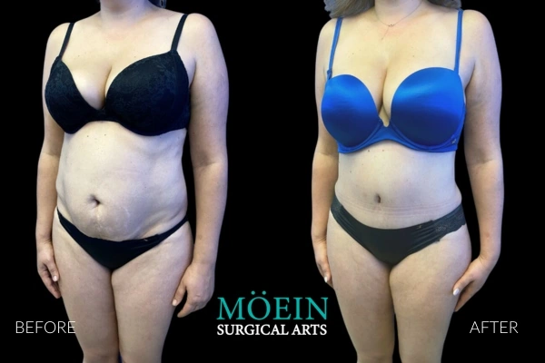 Mommy-Makeover-Before-and-After-Los-Angeles-CA