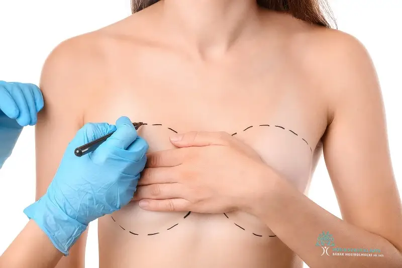 Optimal Timing for Breast Lift Surgery