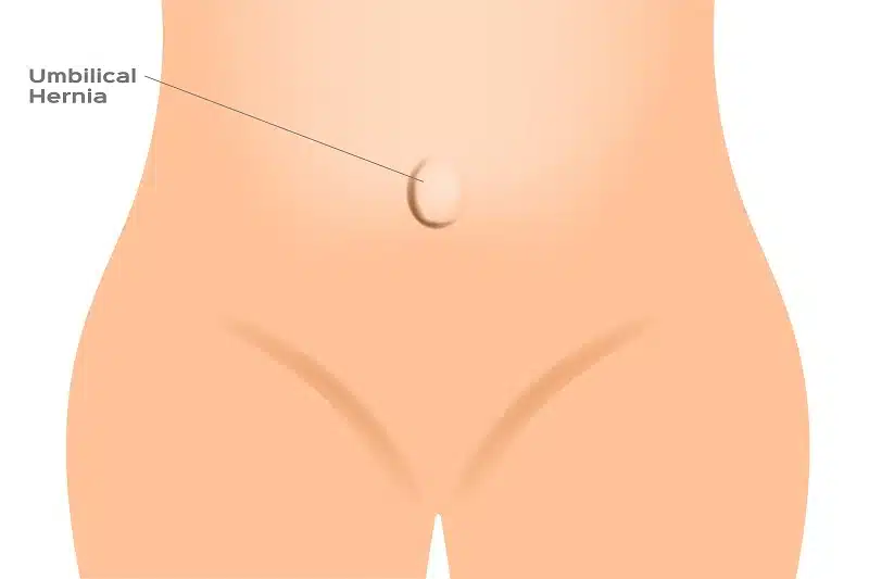 Preventing Recurrence Umbilical Hernia in Los Angeles, CA