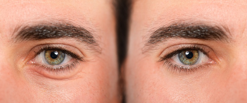 Surgical options for permanent Eye Bags removal