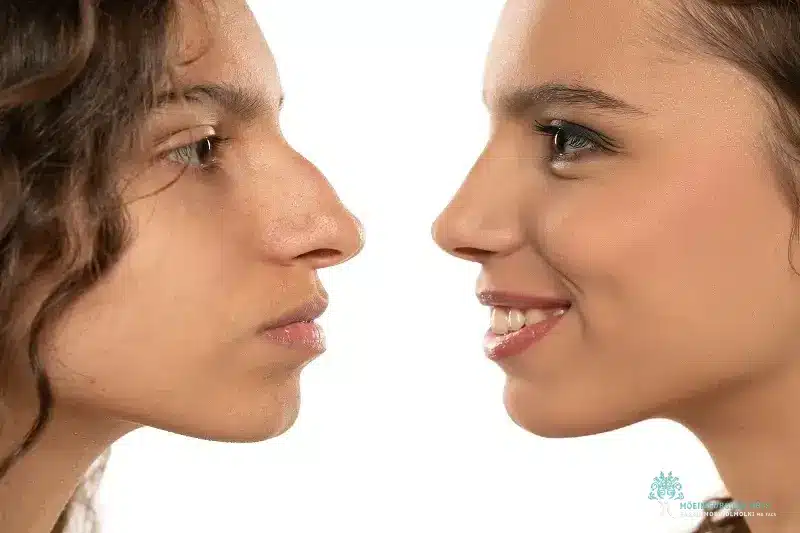 Rhinoplasty LA, CA- Moein Surgica Arts