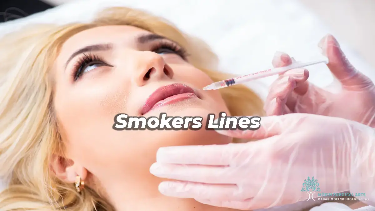 Smokers Lines- Treatment in LA CA