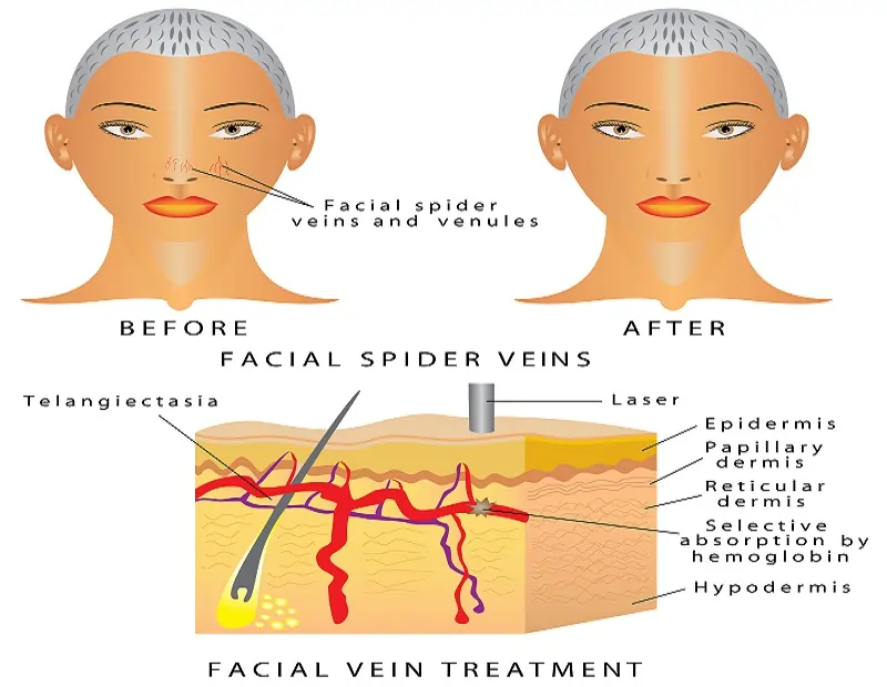 Spider Veins on face