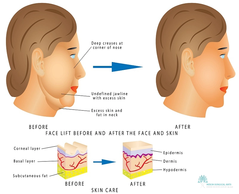 Strategic Incisions in Mini Facelifts for Natural Results