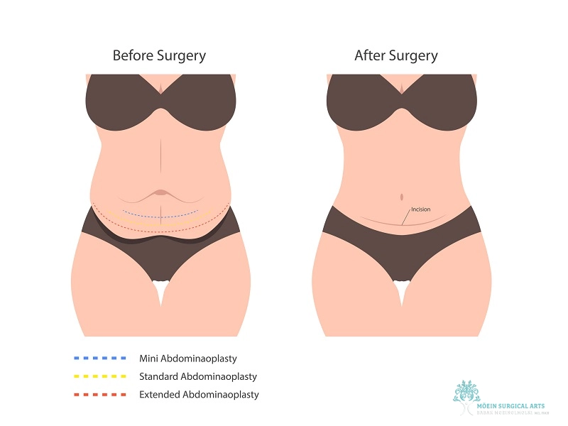 Surgical Options for Diastasis Recti