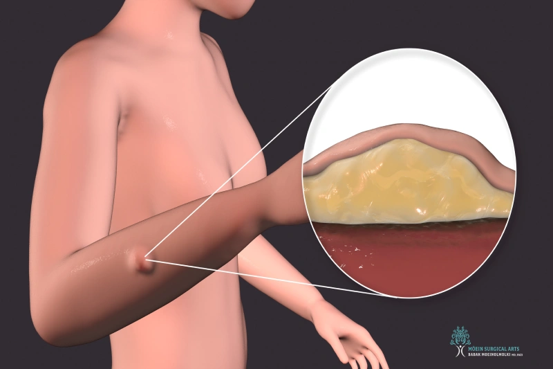 Symptoms of Lumps and Bumps Symptoms of Lumps and Bumps- Insights from Dr. Moein In Los Angeles, CA