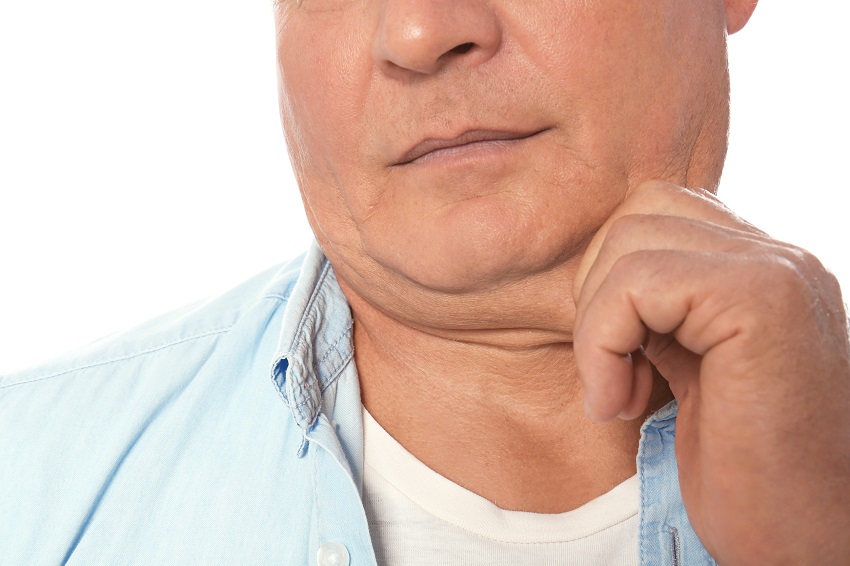 The role of aging in Double Chin development