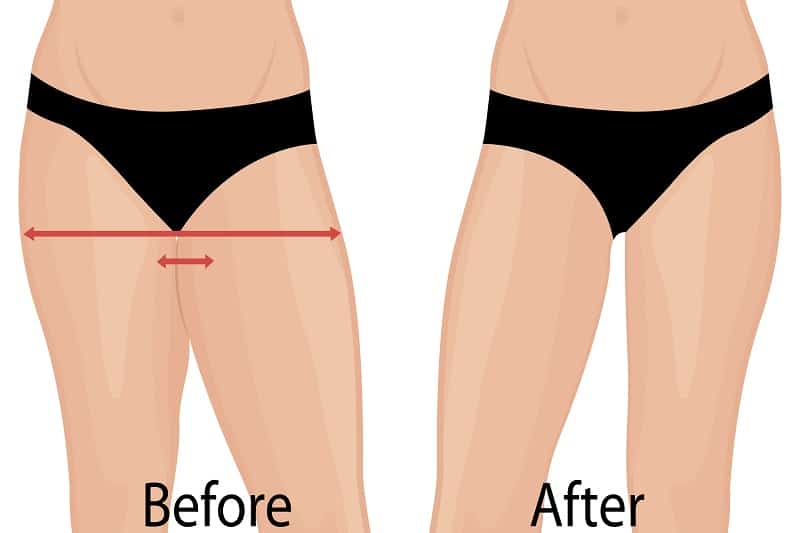 Thigh lift in LA, CA-
Get tips from Dr. Moein