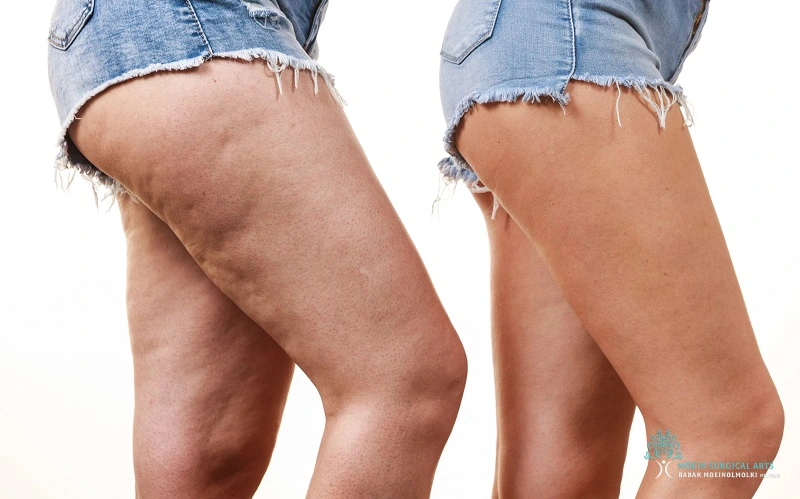 Treatment Options for Cellulite in LA