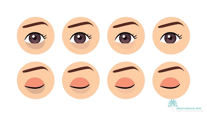 Treatment Options for Dark Circles Removal Treatment Options for Dark Circles Removal in LA