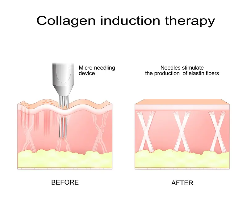 Treatment Options for Smoker Lines in Los Angeles, CA