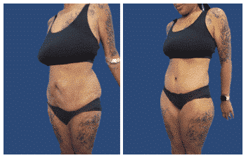 LA Cosmetic Surgeon specializing in tummy tuck procedures, showcasing stunning before and after transformations.