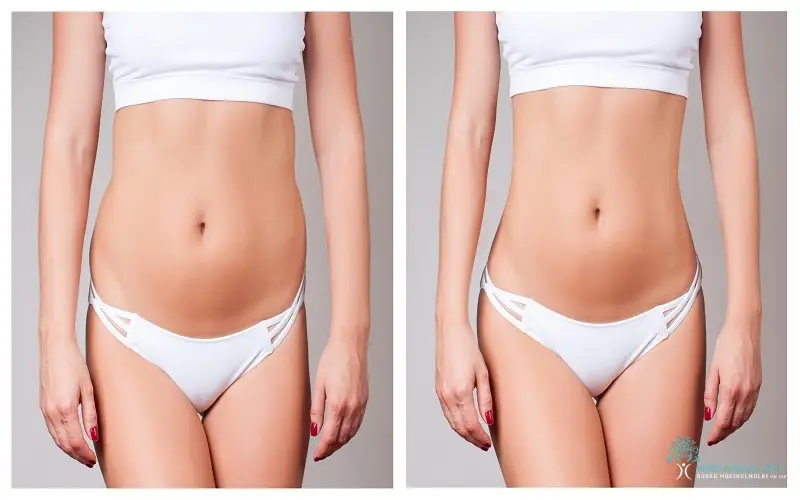 Tummy Tuck Vs Liposuction or Both- Dr. Moein in Los Angeles, CA