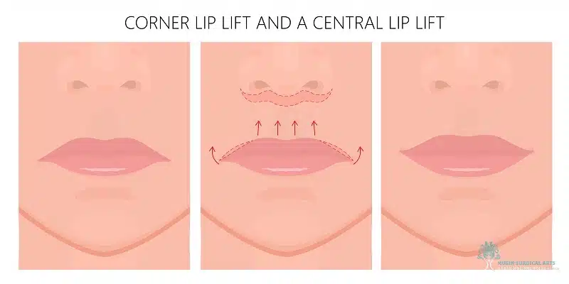 Types of Lip Lifts- CORNER LIFT