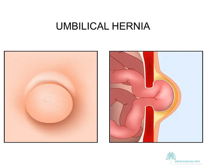 Umbilical Hernia Los Angeles, CA