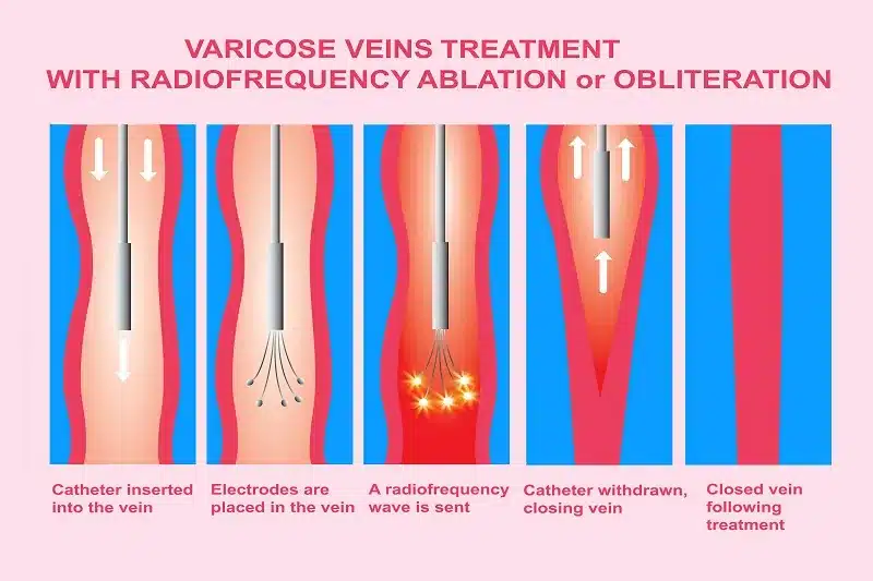 Varicose Veins. Treatment Los Angeles, CA