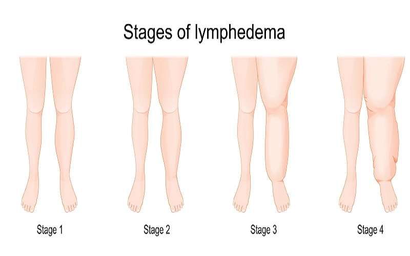 What is Lymphedema?