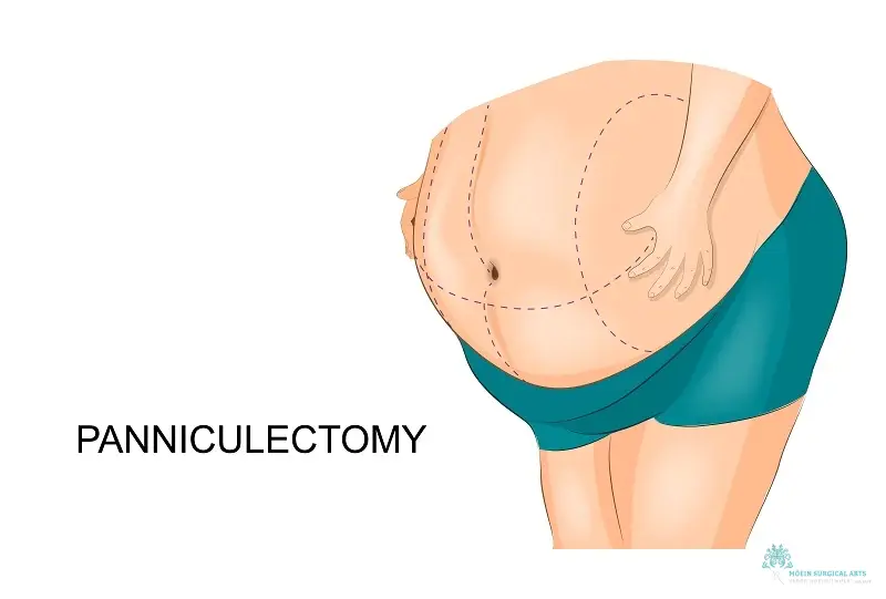 What is Panniculectomy in Los Angeles, CA