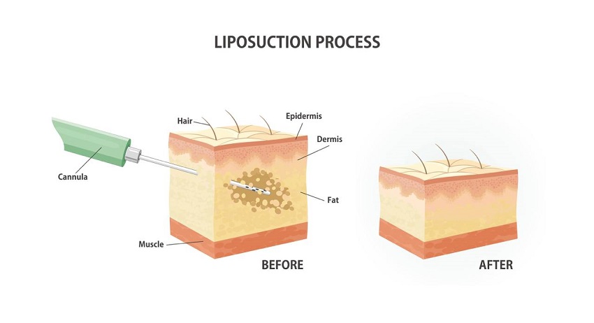 What is Traditional Liposuction?