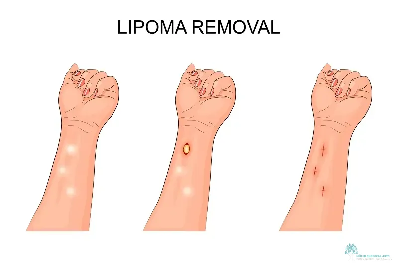 What is lipoma removal- Get tips from Dr. Moein in LA, CA