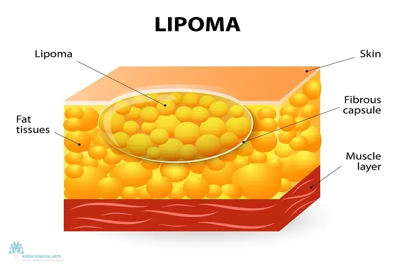 What is the treatment for lipomas in Los Angeles, CA