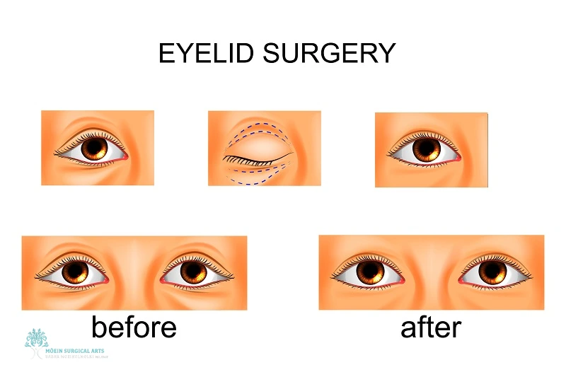 What to Expect During Lower Eyelid Surgery in Los Angeles