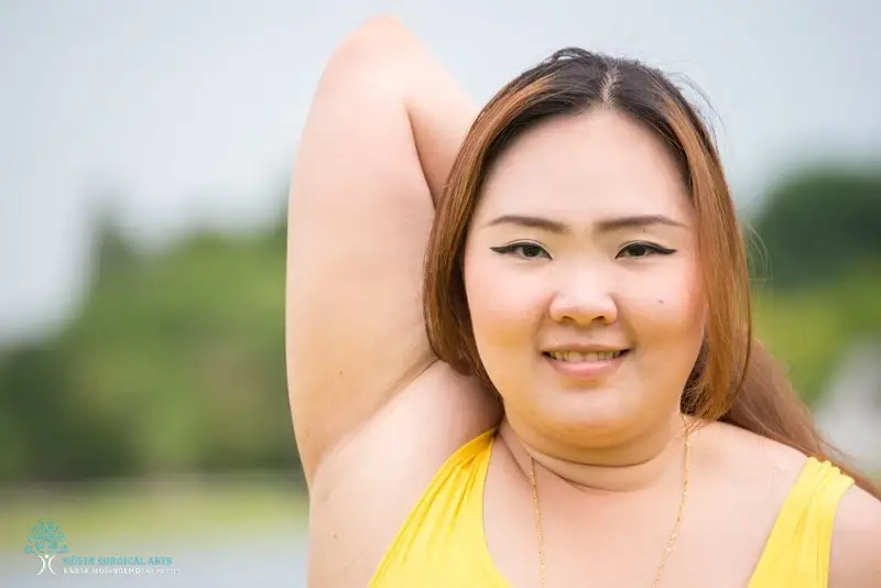 armpit fat removal Recovery in Los Angeles, CA