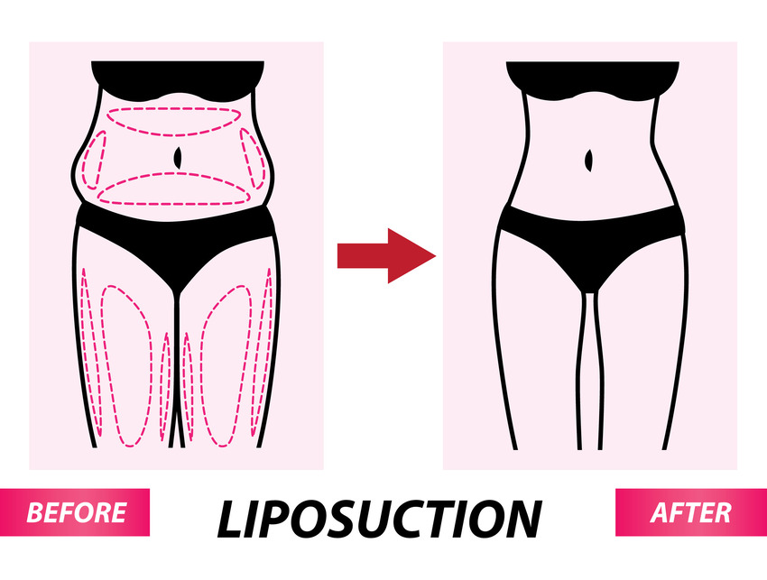 average liposuction cost near me