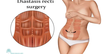 Diastasis Recti Surgery Options in Los Angeles