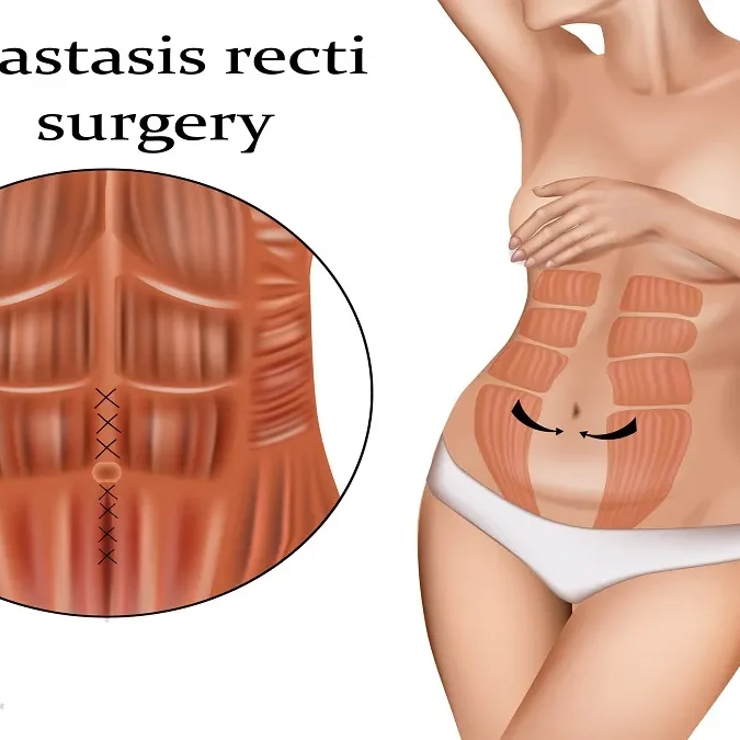 Diastasis Recti Surgery Options in Los Angeles